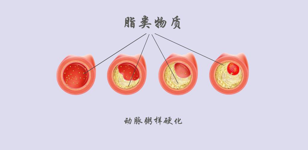 太全了!动脉粥样硬化的治疗方法都在这里!