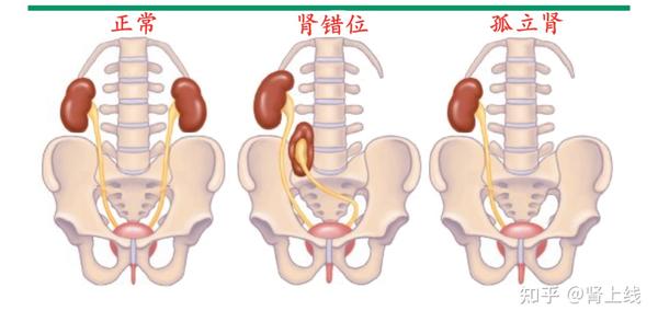 只有一个肾有什么不好的影响吗怎么保养来听听肾科医生怎么说