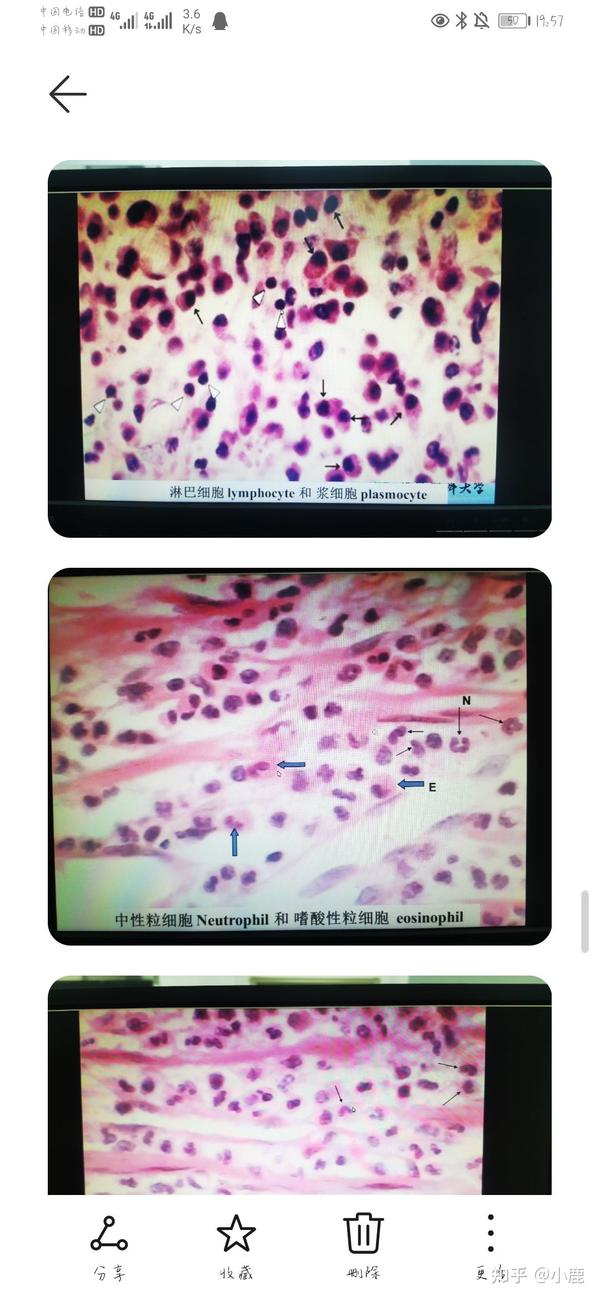 部分病理学切片红蓝铅笔手绘图,画的有一点点丑