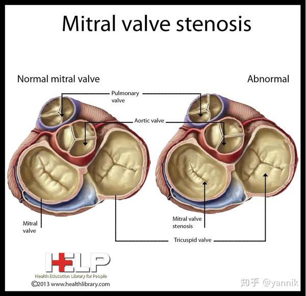 前后瓣叶链接处——"交界"的融合导致风湿性二尖瓣狭窄(mitral valve