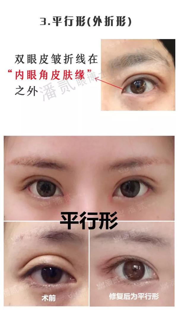 为什么不主张中国人做欧式平行双眼皮