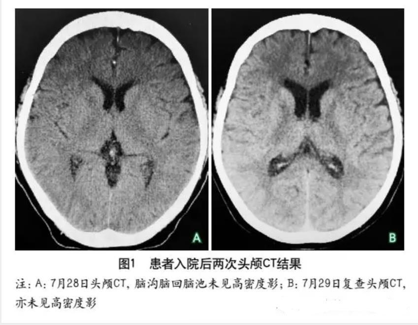 以发热起病的头颅ct阴性的蛛网膜下腔出血1例