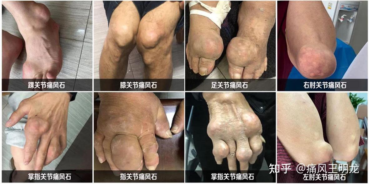 左脚无名脚趾肿痛是痛风吗
