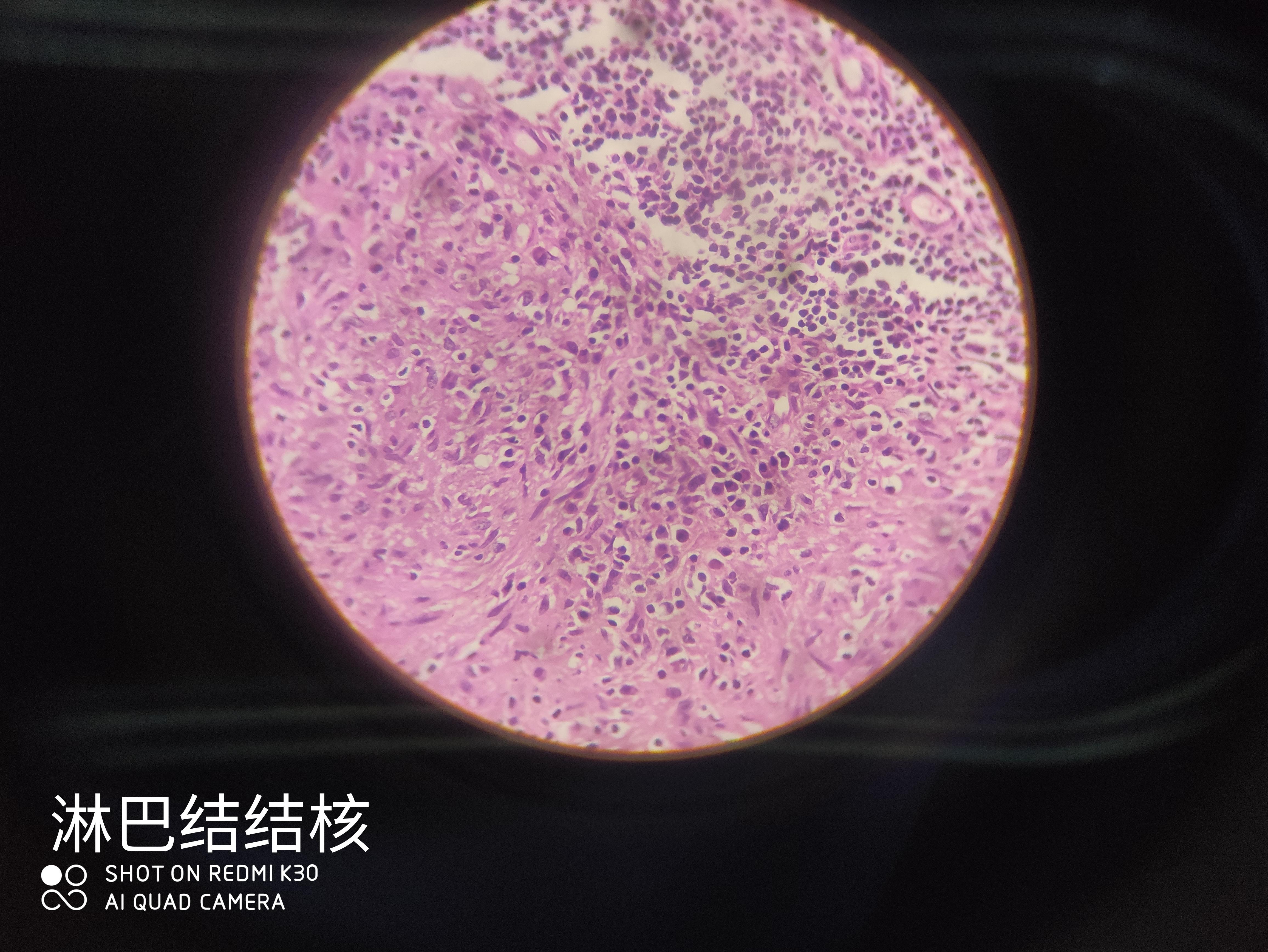 类上皮细胞也不是空泡状的蜂窝织炎性阑尾炎注意胞浆与胞核的形状与