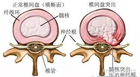 腰椎间盘突出自我疗法