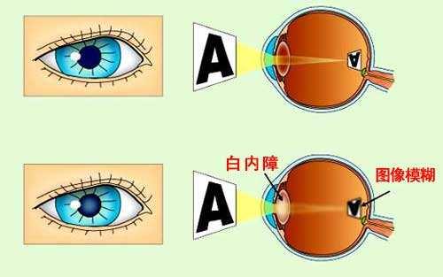 18 人 赞同了该文章   白内障是一种眼科疾病当中的顽疾,凡是各种