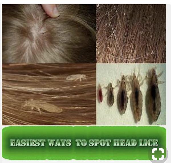 理发师说头发经常绑着容易出现毛管虫,毛管虫是什么来