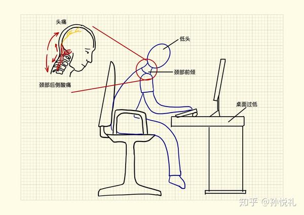 低头伸颈的姿势使头部重心远超于颈椎最佳承重范围