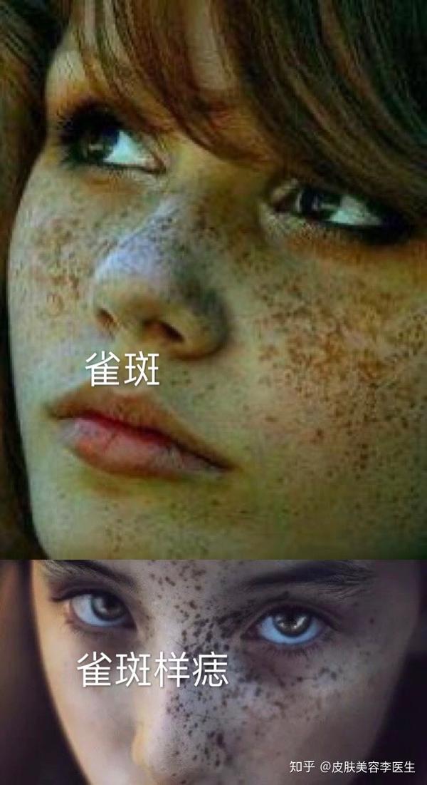 看完这篇雀斑的所有问题你都清楚了