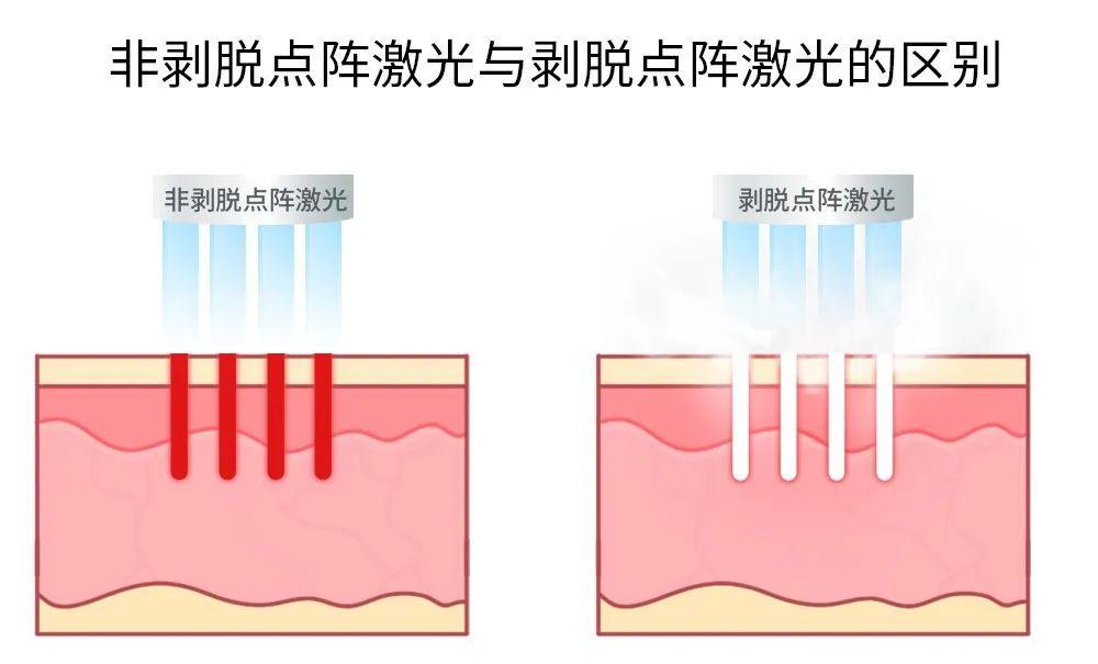 非剥脱点阵激光和点阵激光都能治疗痘坑为什么效果不如点阵二氧化碳