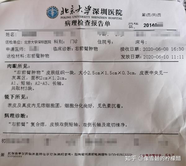 手部黑色素痣切除—北京大学深圳医院