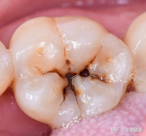 牙齿出现小黑洞,说明引起中度蛀牙,细菌腐蚀来到牙本质,伴随着牙齿
