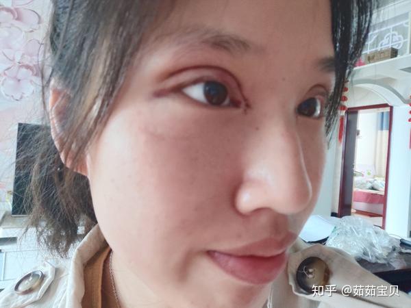 割双眼皮你后悔嘛