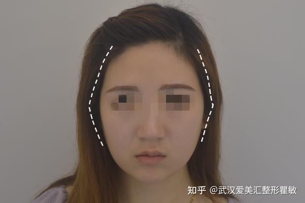 做完面部填充脸会变大?真相是