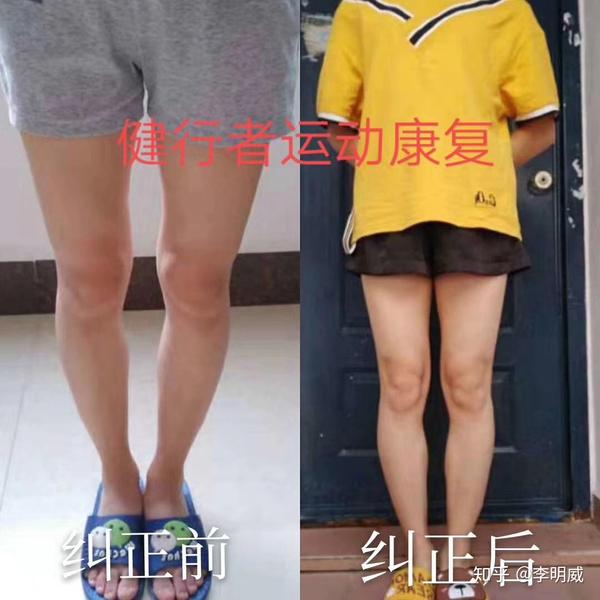 o型腿运动矫正效果显著