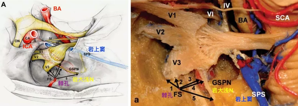 脑血管解剖学习笔记第2期:棘孔的解剖