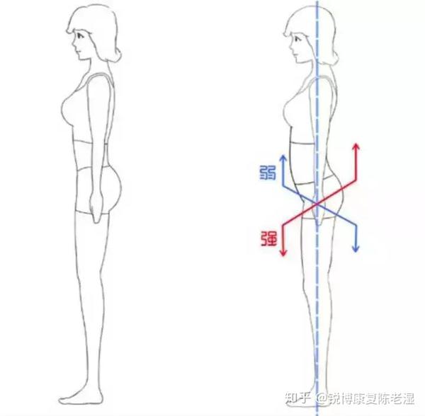 如何改善骨盆前倾?