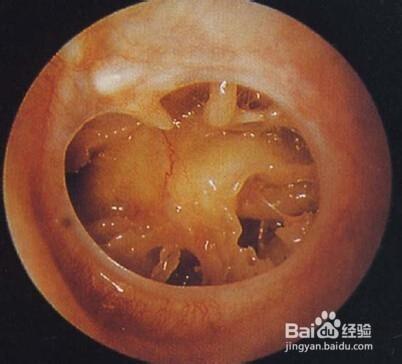 慢性化脓性中耳炎搞混,今天我们就来详细了解一下胆脂瘤