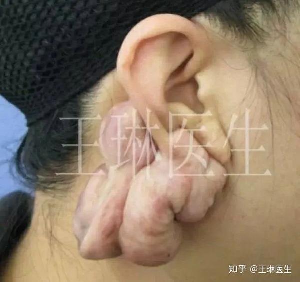 有一个很重要的话题就是:打耳洞或者取耳软骨之后形成的瘢痕疙瘩,耳部