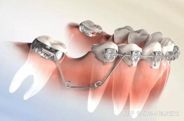 矫正牙齿时,医生说的扩弓,片切和磨牙后推是什么?