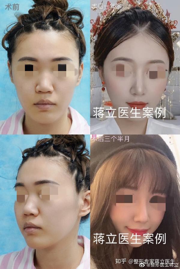 术前塌鼻蒜头鼻短鼻肉鼻