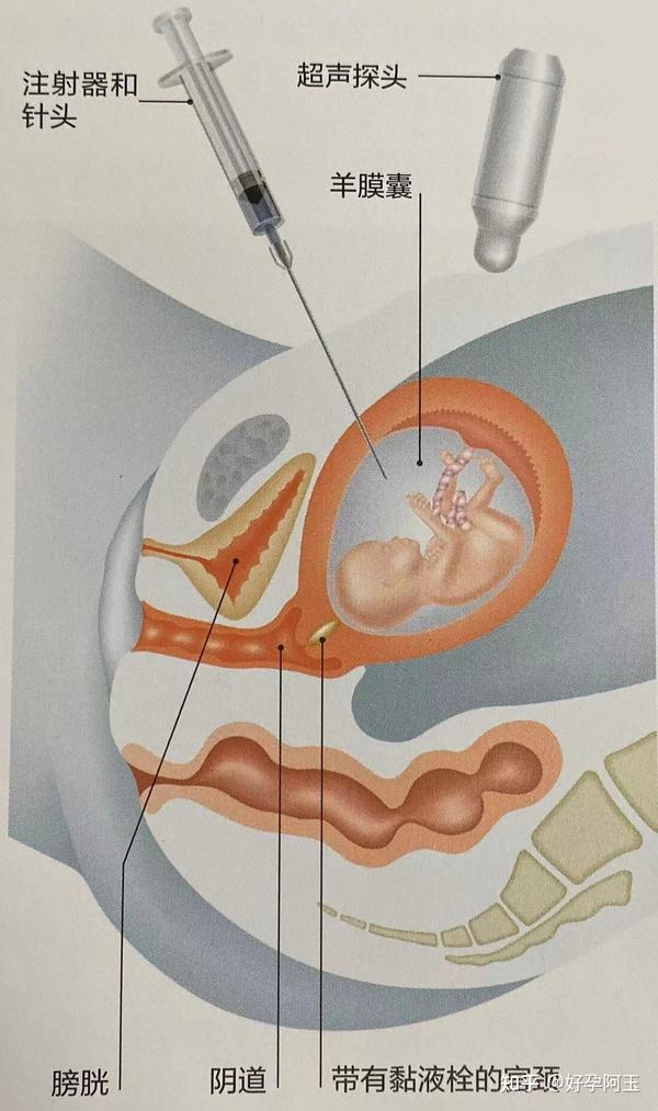 图3.羊膜腔穿刺