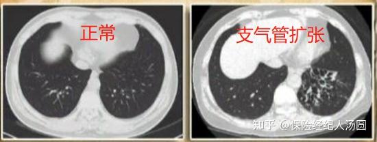 支气管扩张伴感染 肺小结节影,重疾险标准体承保!