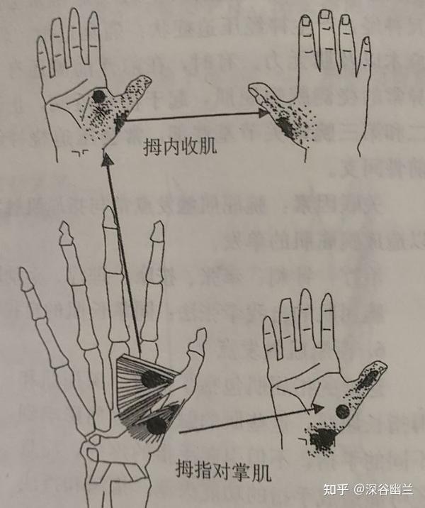 拇内收肌和拇对掌肌触发点及其牵涉痛位置