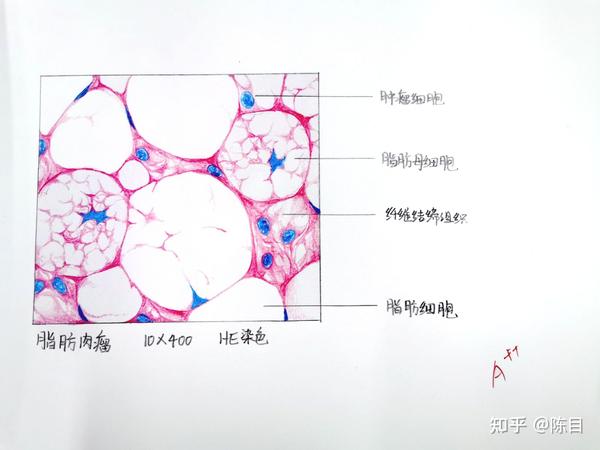 食管鳞状细胞癌 8.胃腺癌 9.脂肪肉瘤 10.动脉粥样硬化 11.