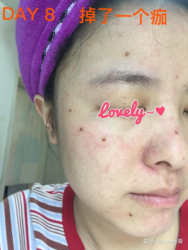 激光点痣小记录