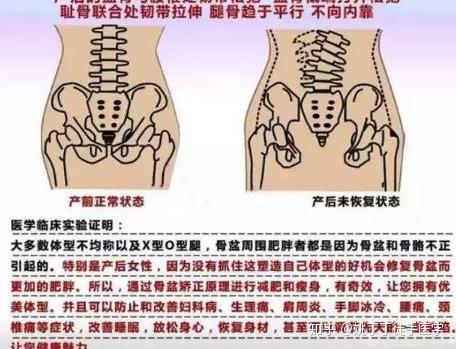 产后骨盆修复,你听说过徒手骨盆修复吗?