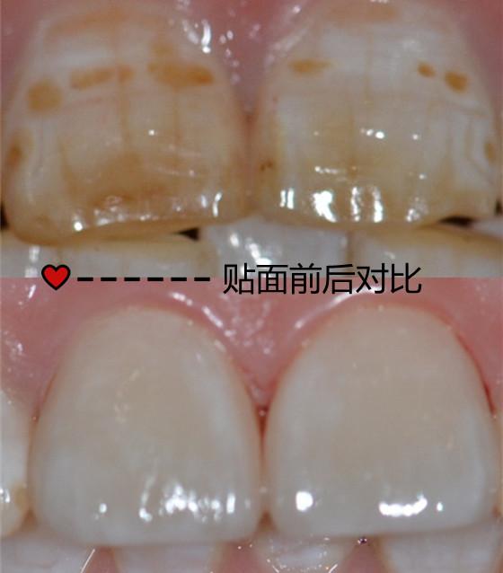 重庆牙齿修复门牙重度氟斑牙瓷贴面修复