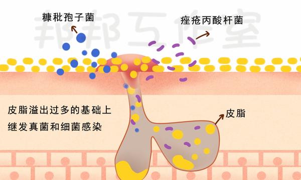 脸部脱皮又泛红得了脂溢性皮炎怎么办