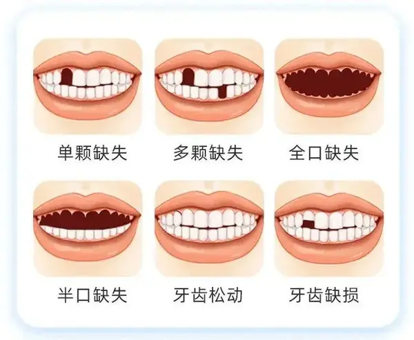 缺牙危害不可小觑这四种适合不同人群的缺牙修复方式和修复亮点教市民