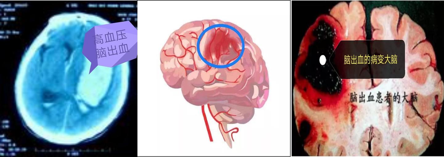 脑出血的成因,发病征兆和预防