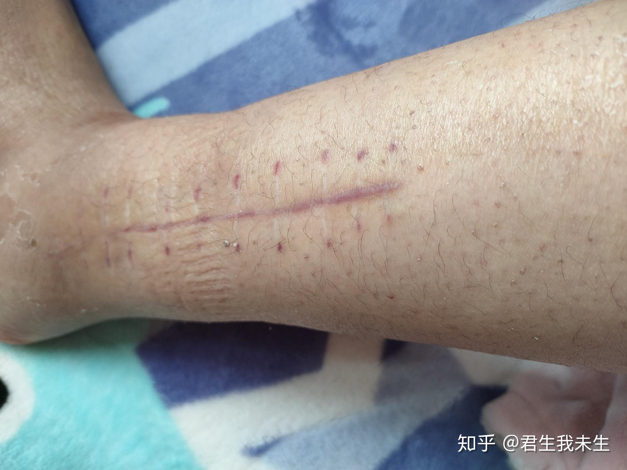 胫腓骨粉碎性骨折后如何康复持续更新