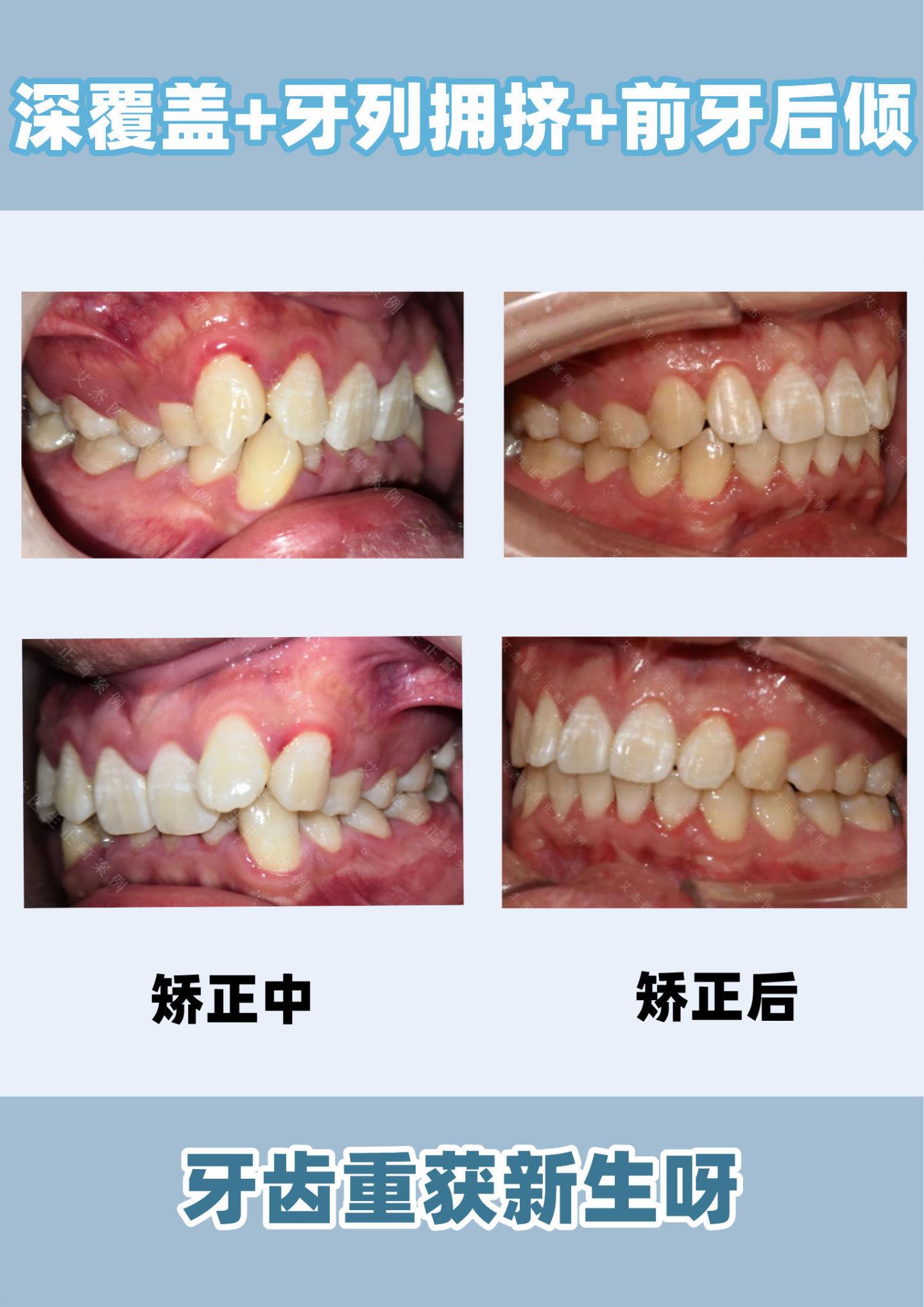 昆明牙齿矫正昆明正畸上下牙列重度拥挤重度深覆颌