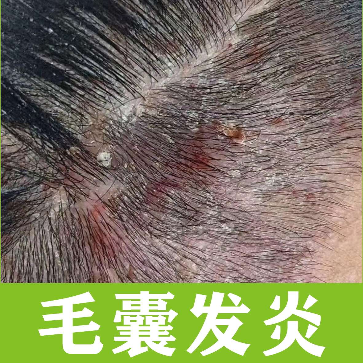 浅表毛囊炎,从病因的角度来说,可以分为感染性和非感染性.