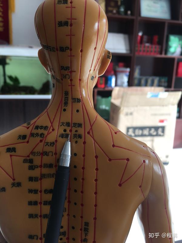 利用拔罐调理头痛问题