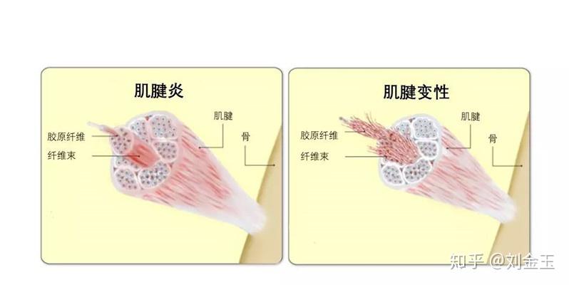 肌腱炎常见的症状有哪些