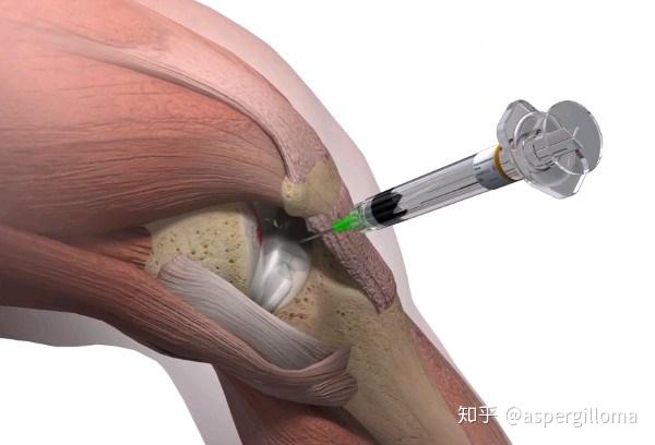 膝关节腔内注射治疗示意图(图片来自互联网)