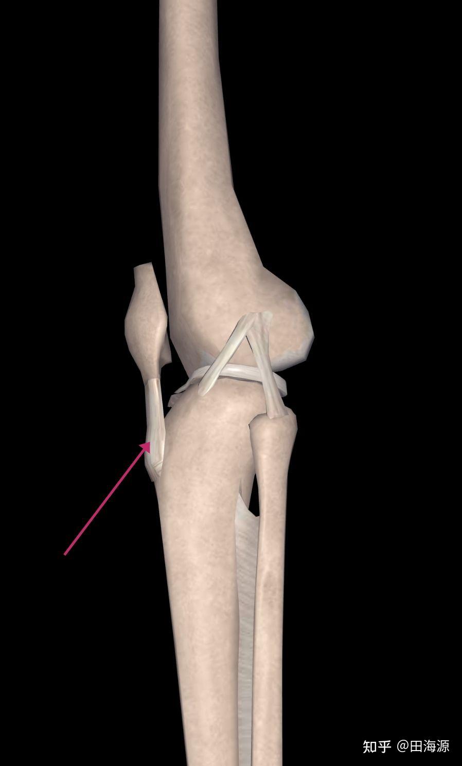 膝盖疼痛的患者,基本都知道这是个啥东西—髌骨带