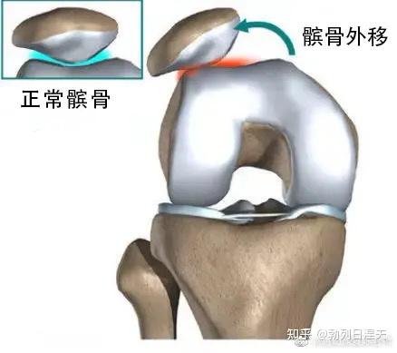 一个髌骨软化患者的康复实验