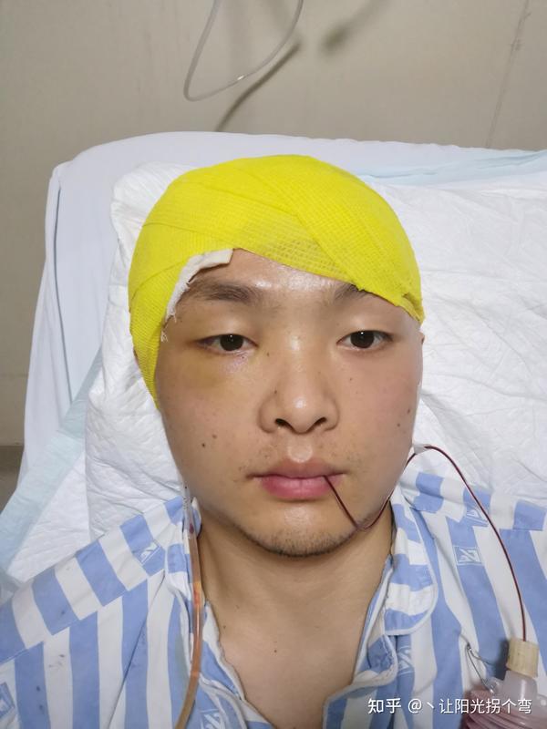 记录一次颧骨骨折