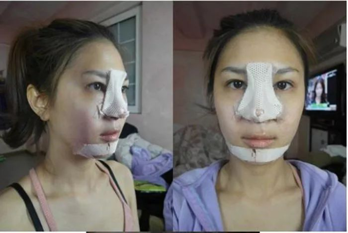 鼻整形为什么要贴胶布填塞鼻腔?
