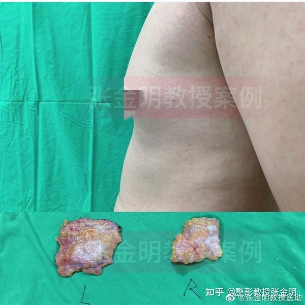 男性女乳怎么缩胸解决?