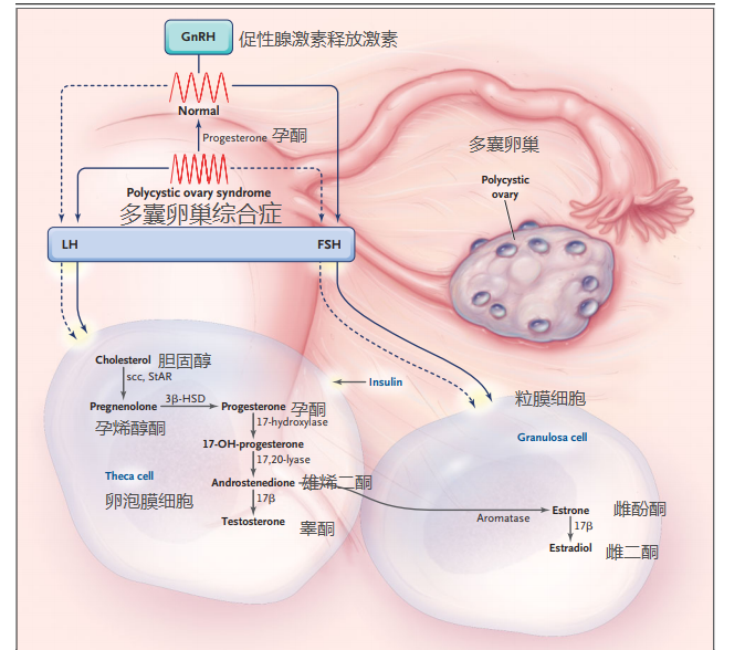 多囊卵巢综合症中的激素分泌与个体表现