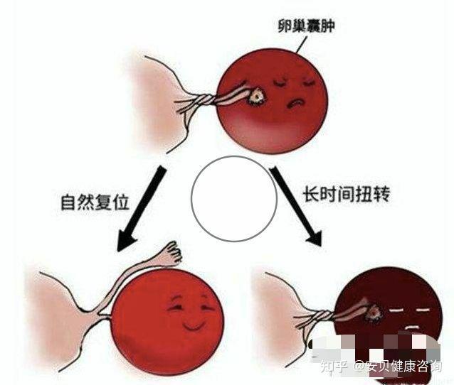 囊肿怎么引起的 知乎