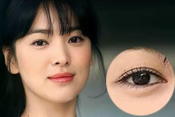 双眼皮的类型有哪几种