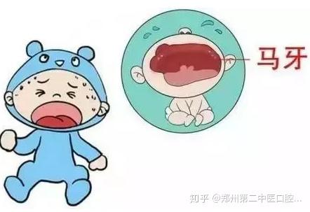 鹅口疮是新生儿的常见病,由白色念珠菌感染而起,症状就是在唇内,上颚